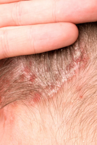 Psoriasis en plaque