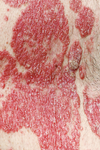 psoriasis erythodermique