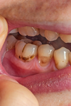 sourire abimé par le déchaussement des dents