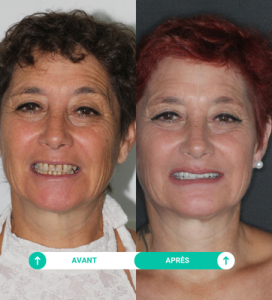 paola patiente soins dentaires Smile Partner exemple