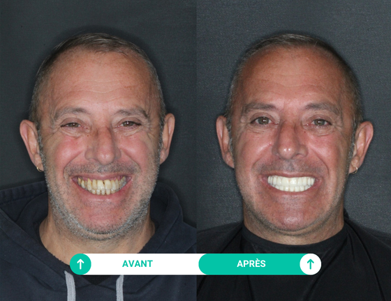 avant apres dentition patient