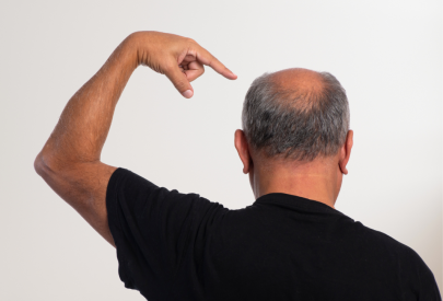 homme avec cheveux dégarnis sur le crâne (tonsure)