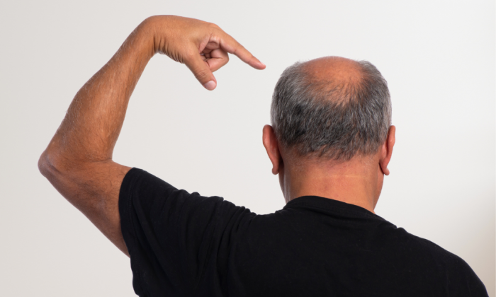 homme avec cheveux dégarnis sur le crâne (tonsure)
