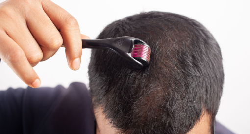 homme qui utilise un dermaroller pour cheveux