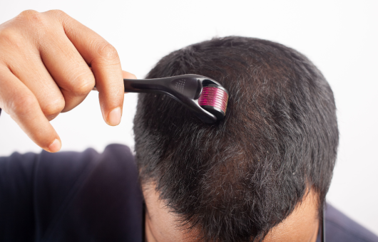 homme qui utilise un dermaroller pour cheveux