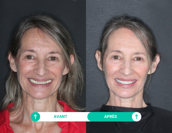 Etude de cas de Sylvia ayant réalisé ses soins dentaires avec Smile Partner