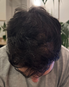 Nicolas 14 mois après sa greffe de cheveux
