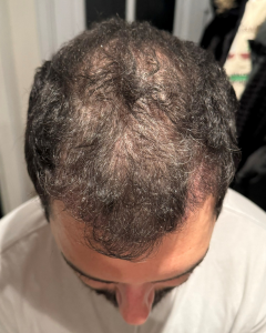 Nicolas 3 mois après sa greffe de cheveux