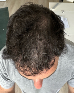 Nicolas 6 mois après sa greffe de cheveux