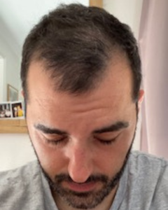 Nicolas avant sa greffe de cheveux