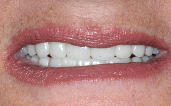 dentition après les soins