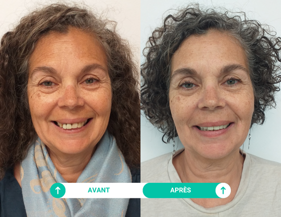 Etude de cas de Nadine ayant réalisé ses soins dentaires avec Smile Partner