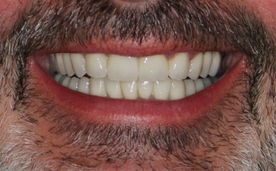 sourire de philippe apres