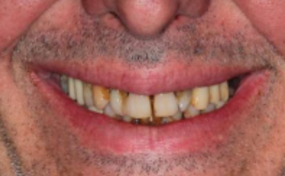 sourire de philippe avant