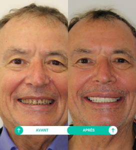 avant apres jean noel