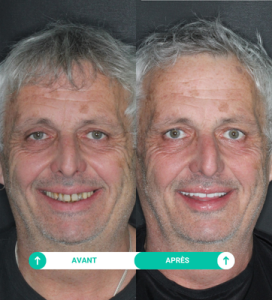 photos avant et après soins de philippe