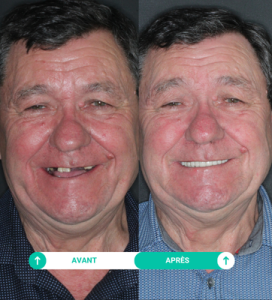 avant apres Jean-Paul clinique dentaire el cedro