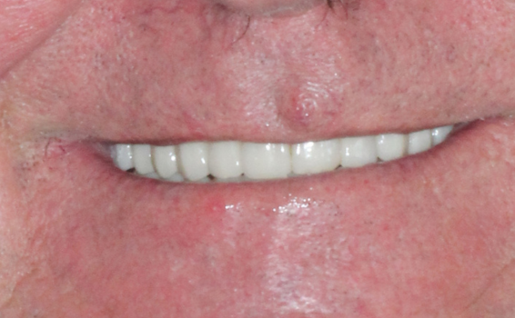 sourire de jean-paul apres