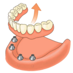 dentier clipsé sur implants