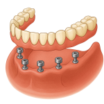 dentier visé sur implants