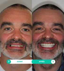 avant apres soins dentaires