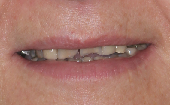 sourire-valerie-avant