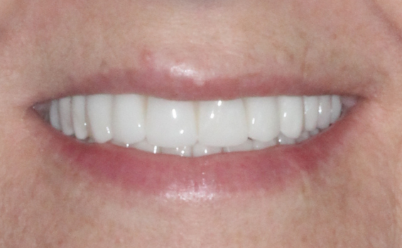 sourire-valerie-apres