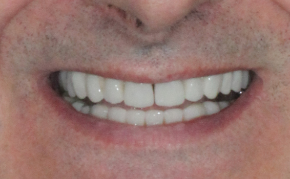 photo-apres-soins-dentaires