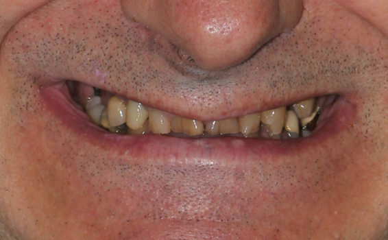 photo-avant-soins-dentaires