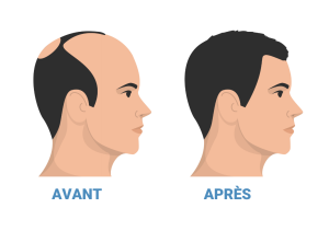 avant apres greffe de cheveux