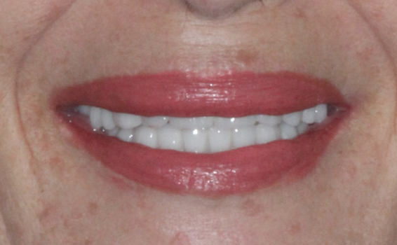 sourire de nathalie apres