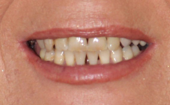 sourire de nathalie avant