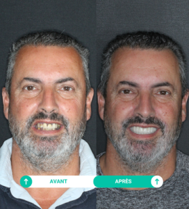 avant apres Jean Mnauel clinique dentaire el cedro