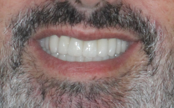 sourire de jean-manuel apres