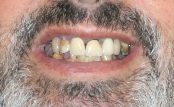 sourire de jean-manuel avant