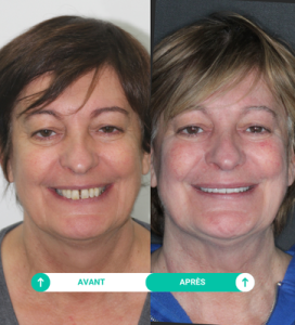 avant apres Sonia clinique dentaire el cedro