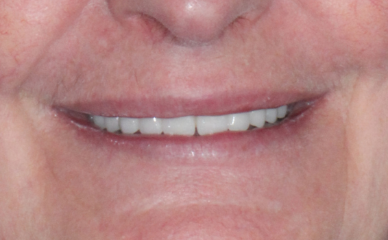 sourire-valerie-apres