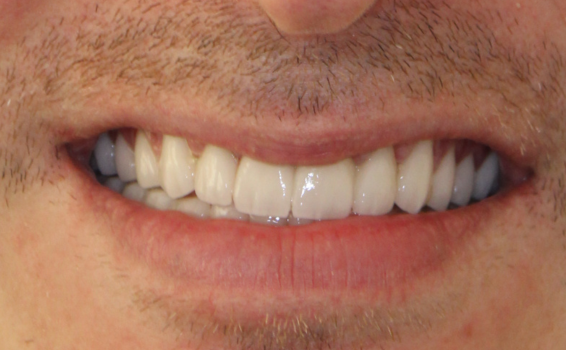 sourire de philippe apres