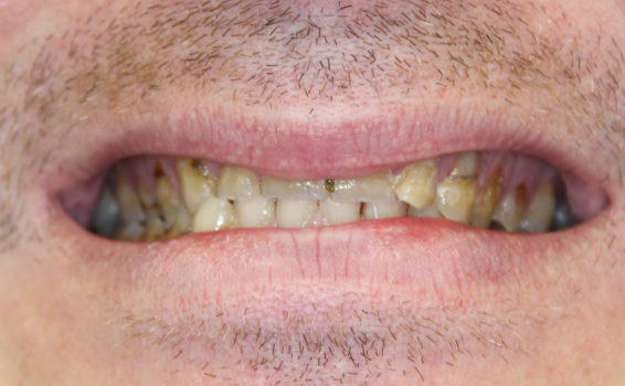 sourire de antoine avant