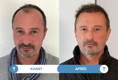 avant-apres-greffe-cheveux