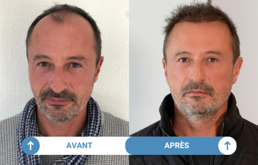 avant-apres-greffe-cheveux