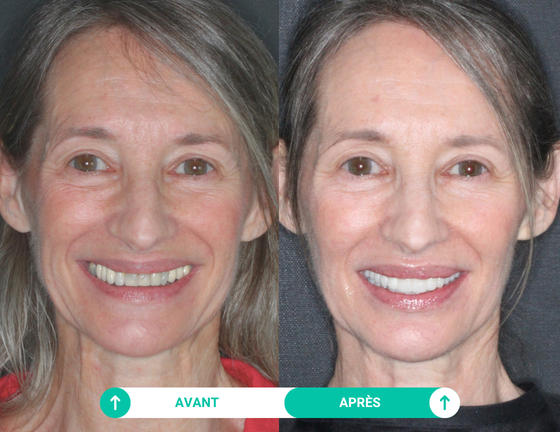 avant apres sourire de Sylvia