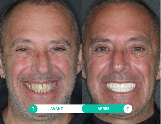 sourire avant apres