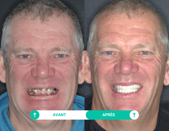 sourire avant apres