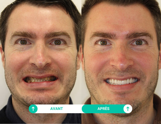 sourire avant apres