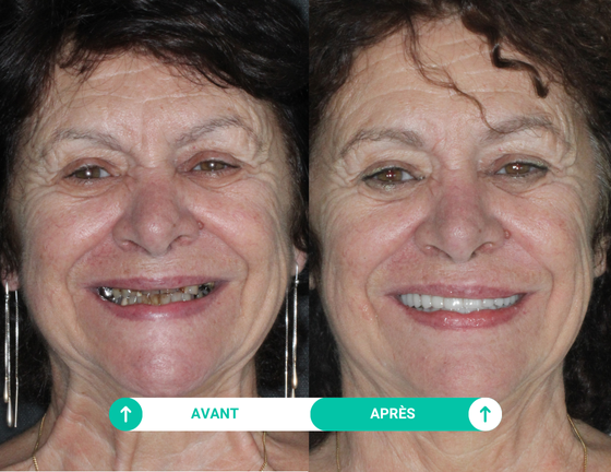 sourire avant apres