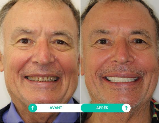sourire avant apres