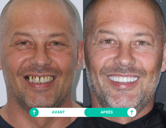 sourire avant apres
