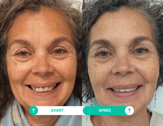 sourire avant apres