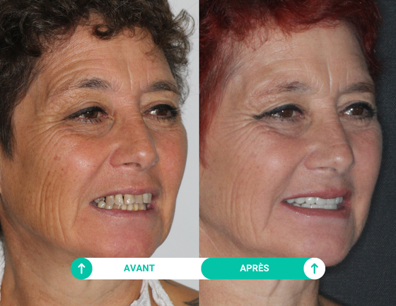 sourire avant apres